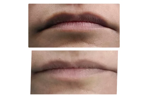 Before and After