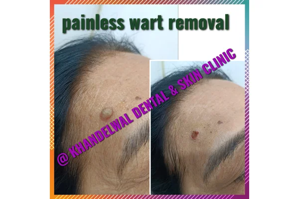 Before and After
