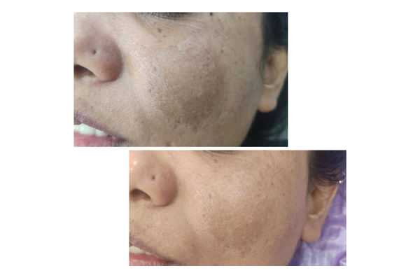 Before and After