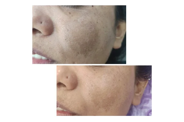 Before and After