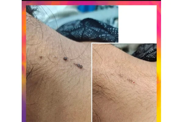 Before and After