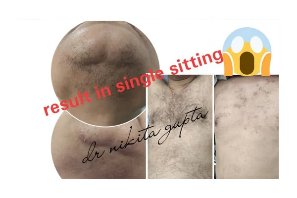 Before and After