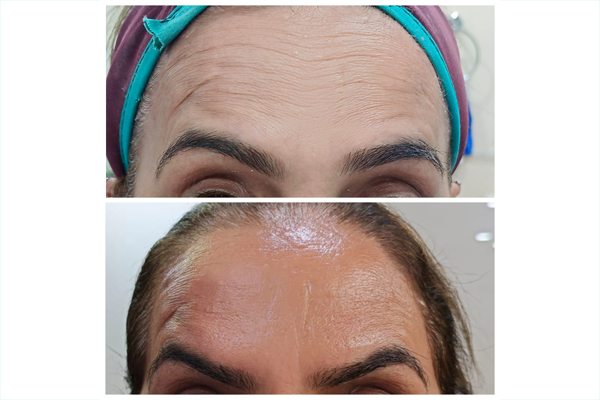 Before and After