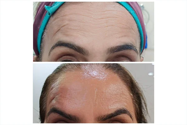 Before and After