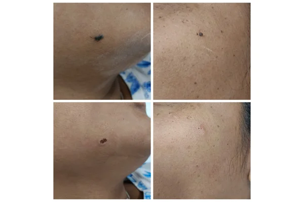 Before and After