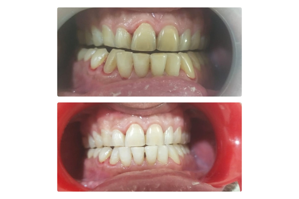 Before and After