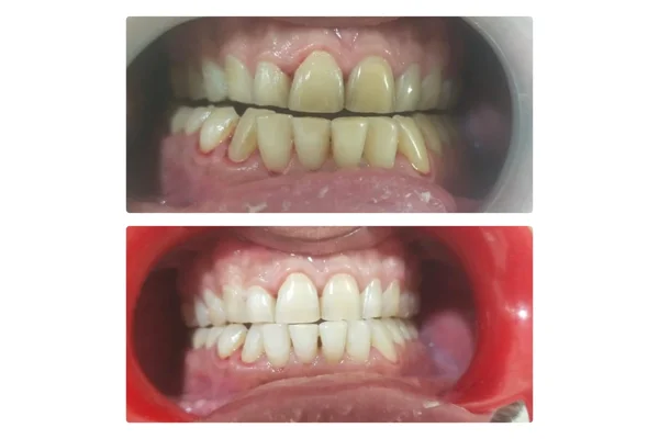 Before and After