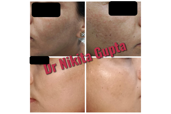 Before and After