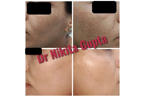 Before and After