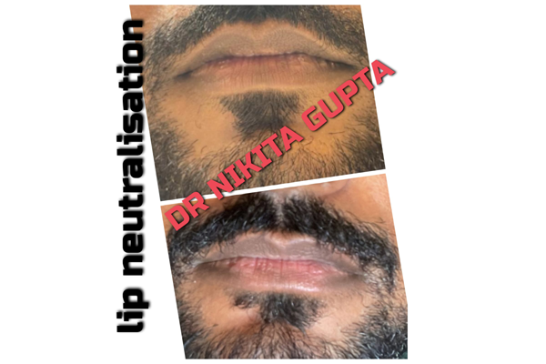 Before and After