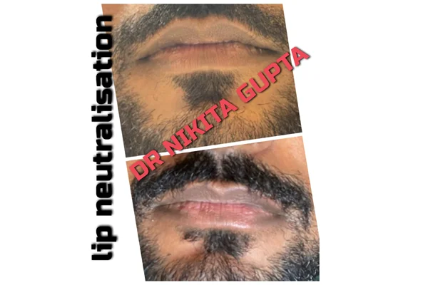 Before and After