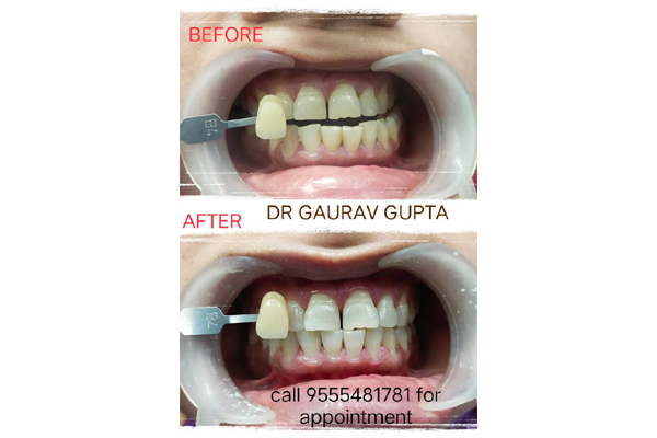 Before and After