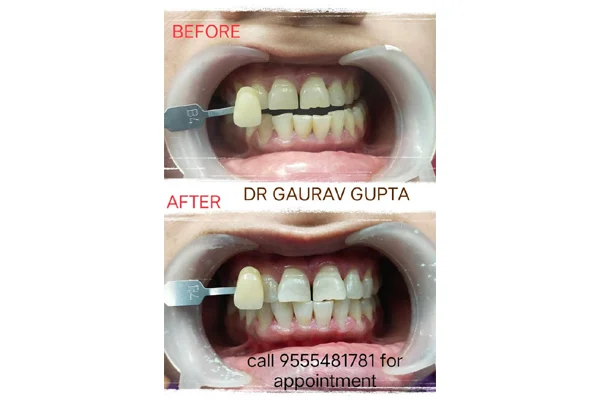 Before and After