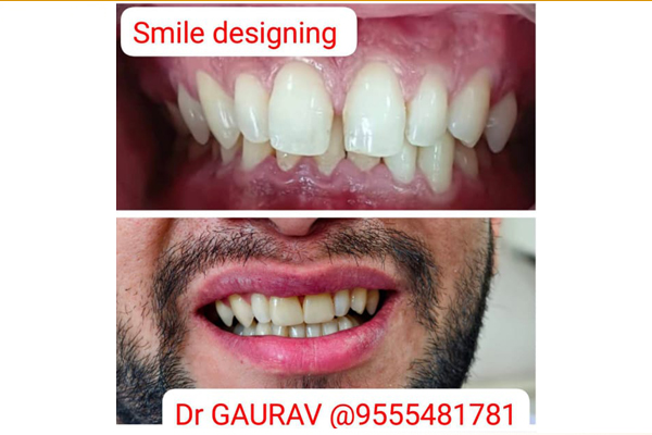 Before and After