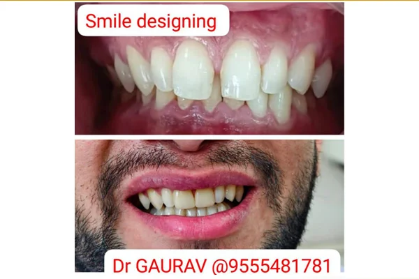Before and After