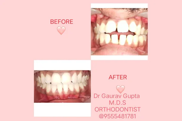 Before and After