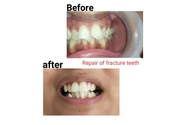 Before and After