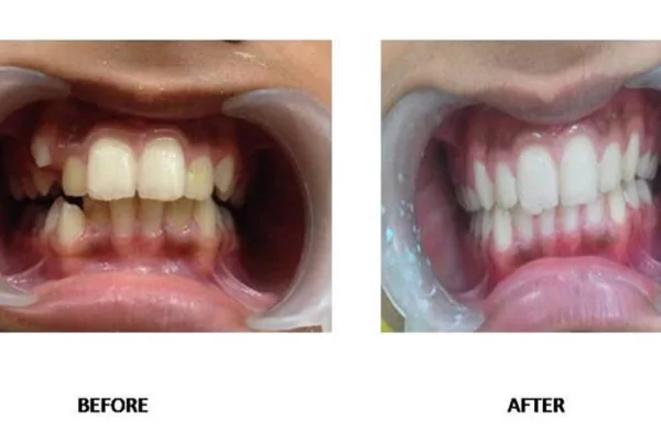 Before and After