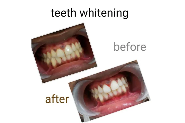 Before and After