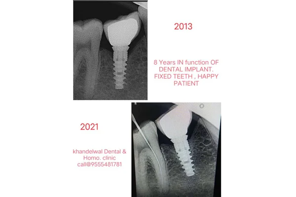 Before and After