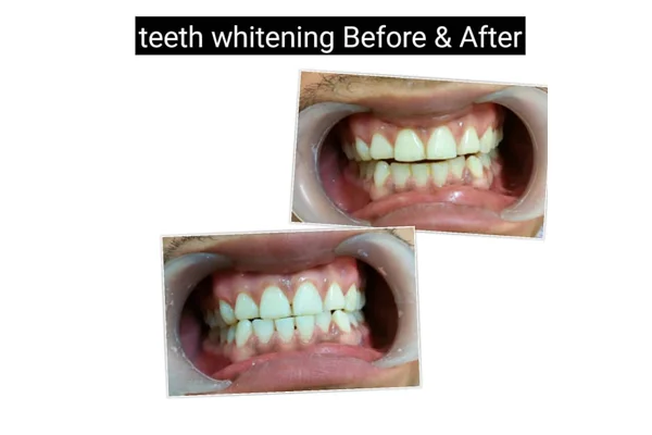 Before and After