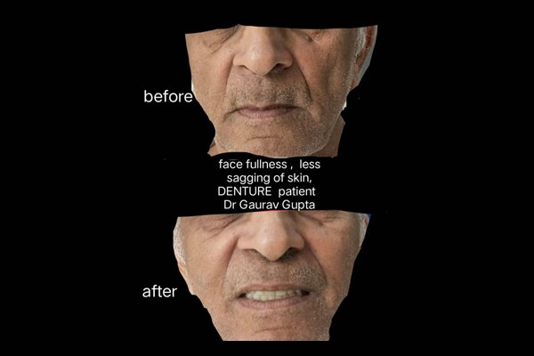 Before and After