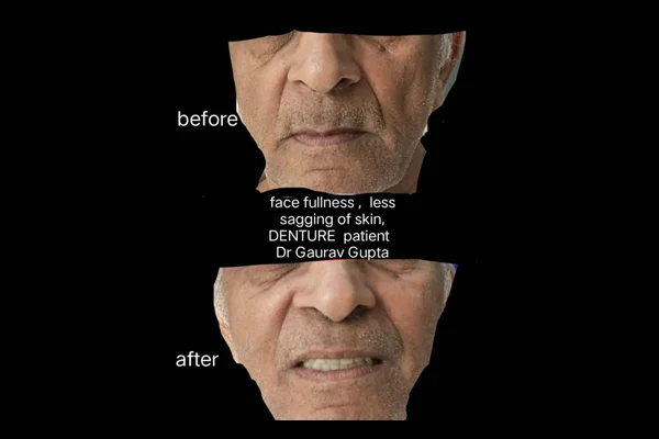 Before and After