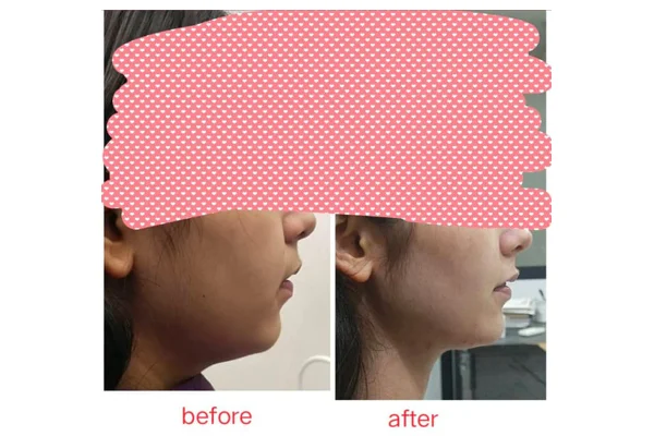 Before and After