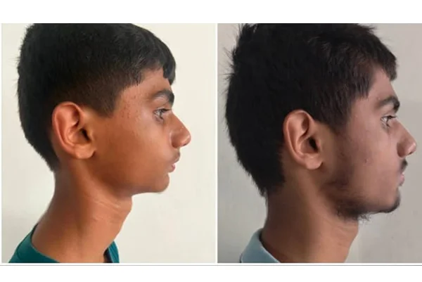 Before and After