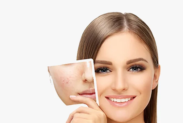 Acne and Scar Treatments